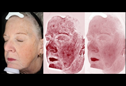 Visia_RBS technology